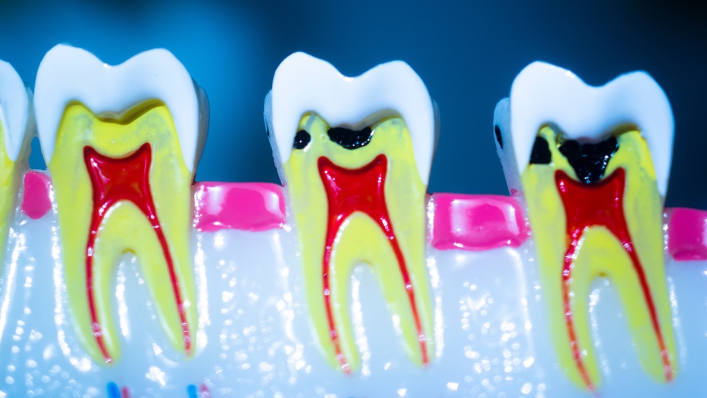 root canal therapy near you