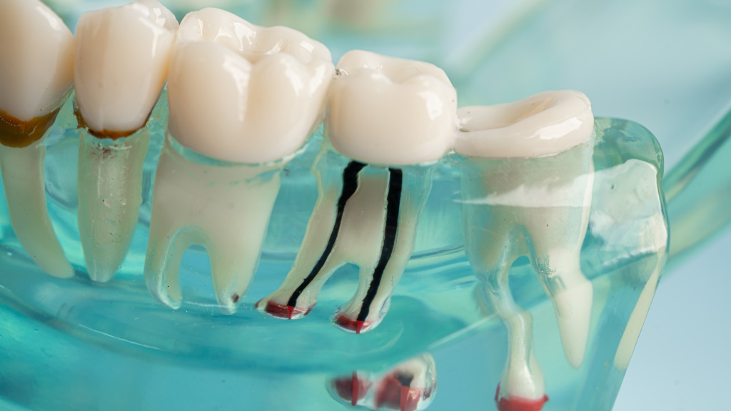 root canal therapy surrey