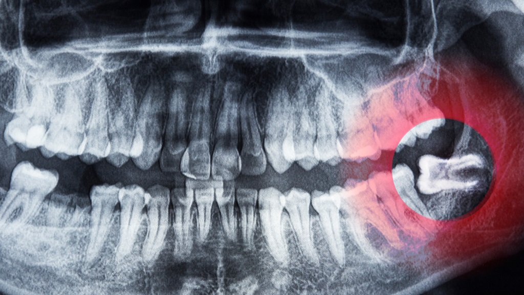tooth extraction surrey
