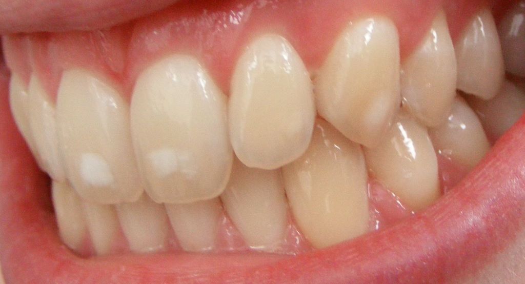 white spot removal