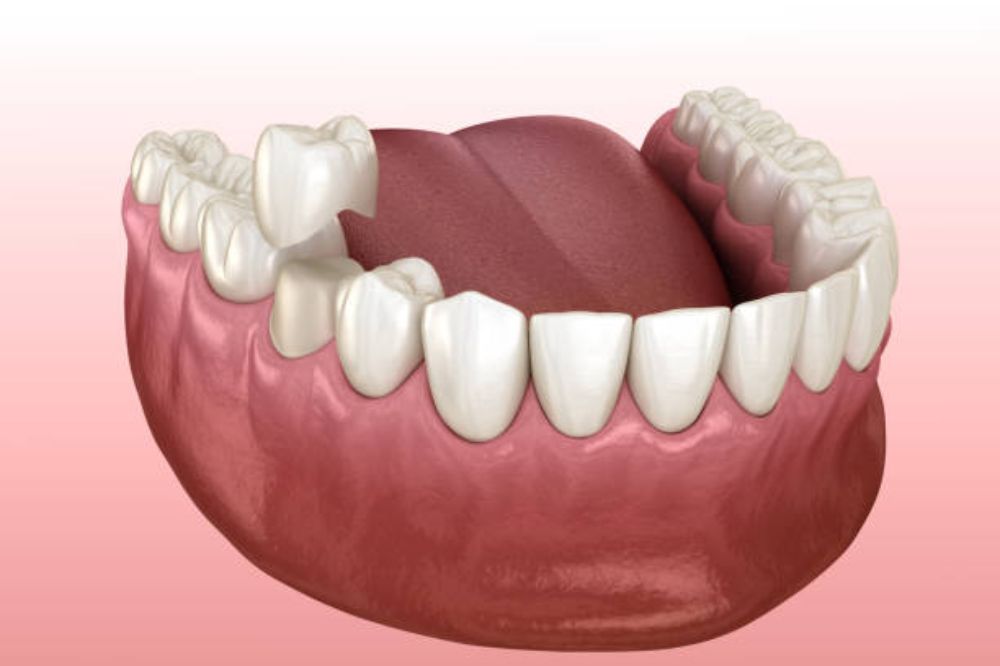 crown lengthening