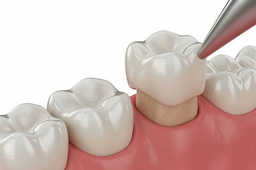 _how-long-does-it-take-to-heal-after-crown-lengthening