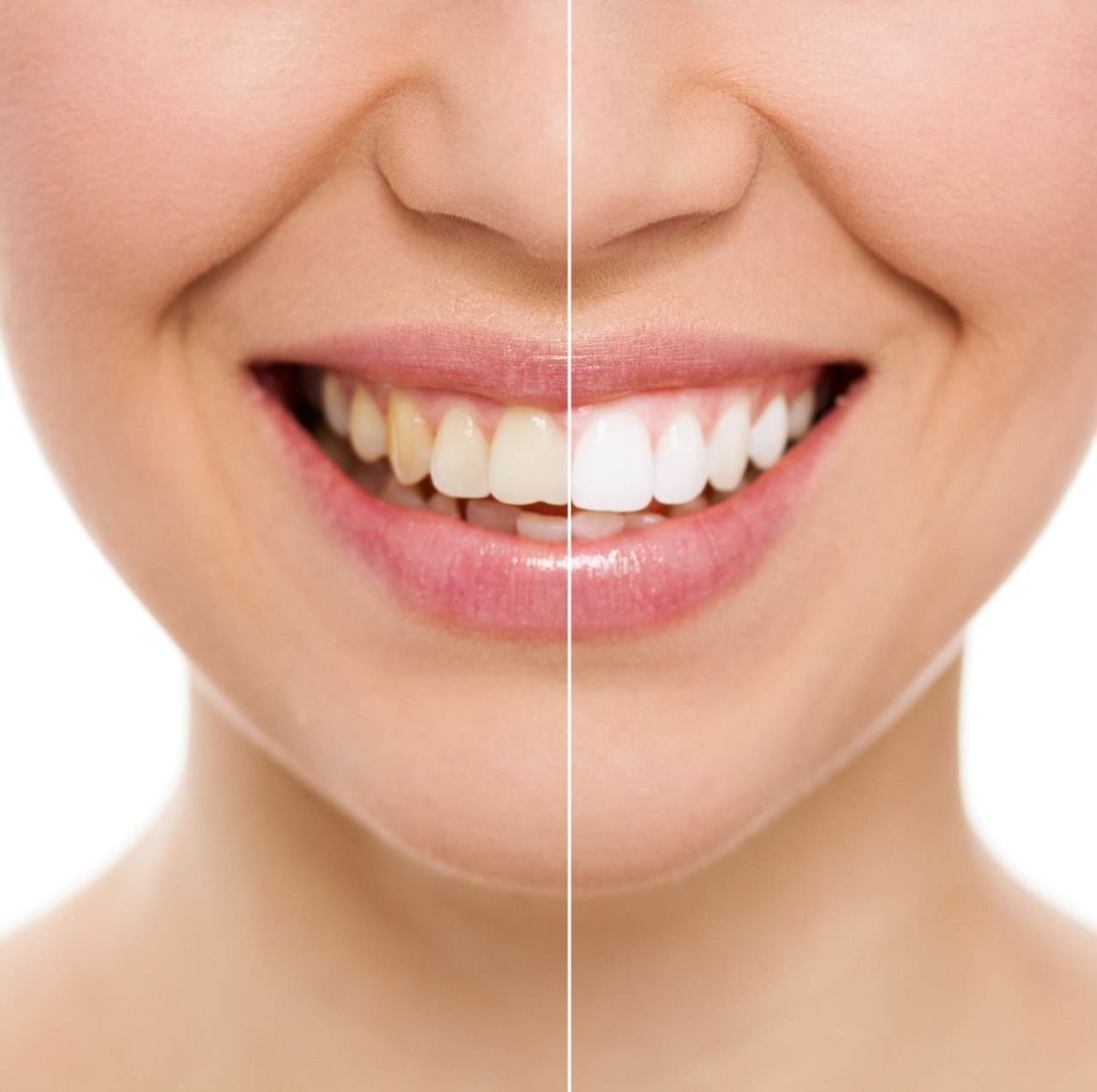 zoom teeth whitening process