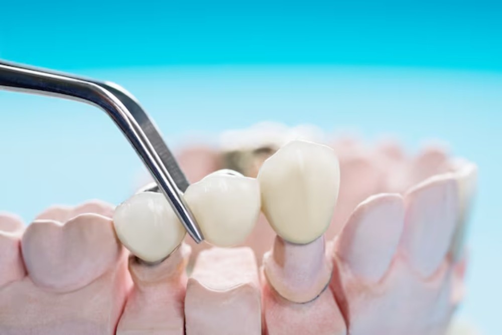 How Do You Know If You Need A Dental Crown