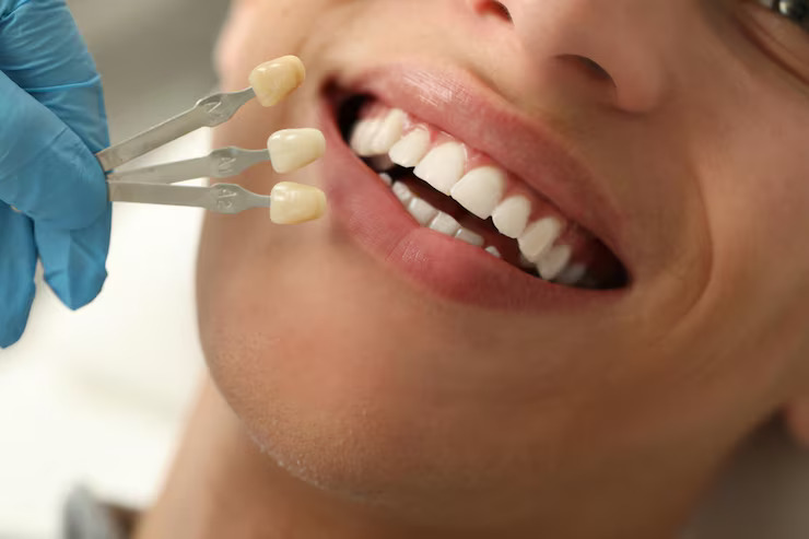Dental veneer treatment